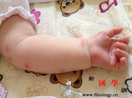 宝宝尘螨过敏的症状是什么_斑疹-丘疹-皮疹-症状-
