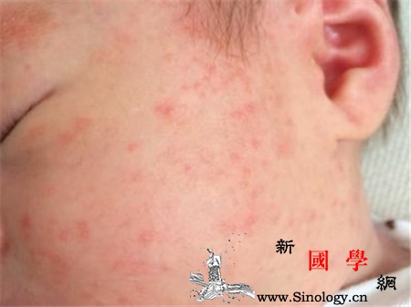 婴儿湿疹可以根治吗要怎么护理才容易好_根治-湿疹-蛋白-婴儿-