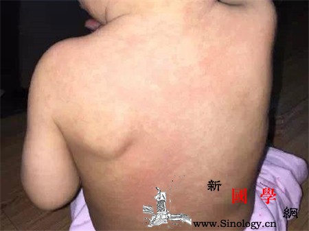 幼儿急疹会拉肚子吗都有哪些症状_疹子-拉肚子-幼儿-传播-