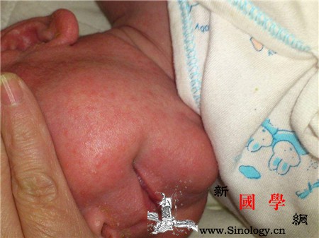 宝宝湿疹会留疤吗要怎么治疗_湿疹-真皮-激素-感染-