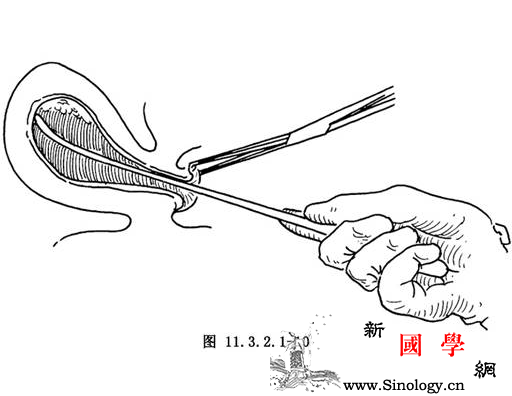 意外怀孕的解决方法_刮宫-性交-解决方法-子宫-