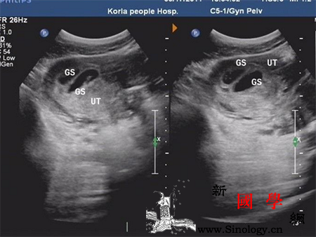 怀孕40天孕囊大小_胎盘-胚胎-胎儿-器官-