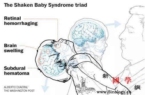 什么是婴儿摇晃综合症_脑部-综合症-摇晃-出血-