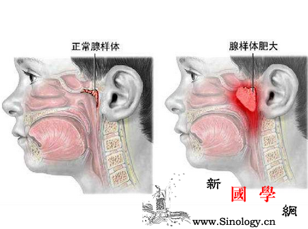 小儿腺样体肥大_肥大-炎症-病因-症状-