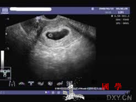 孕囊大小看男孩女孩_羊膜-胎盘-胎儿-形状-