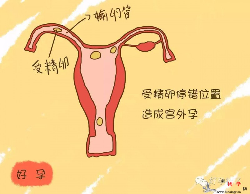 孕期小心这几种肚子疼可能是胎儿有事了！_宫外孕-子宫-收缩-耻骨-