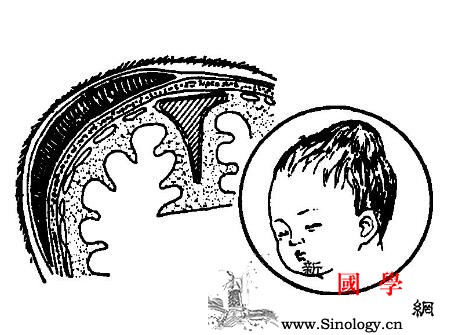 婴儿痉挛症的原因_产钳-初产妇-胎位-癫痫-