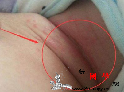 宝宝淹脖子破皮怎么办夏季家长要预防淹脖子_粉剂-夏季-脖子-洗澡-