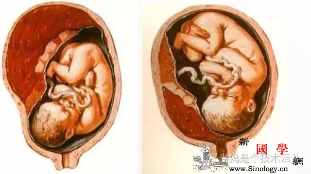 孕晚期出现这个症状必须立即就医可能导致产妇_胎盘-剥离-胎儿-胎位-