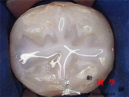 窝沟封闭有必要吗_封闭剂-注射器-磨牙-脱落-