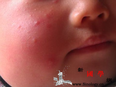 宝宝脸上长小红点_丘疹-痱子-软膏-湿疹-