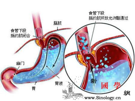婴儿胃食道反流是怎么回事_括约肌-食管-腹腔-黏膜-