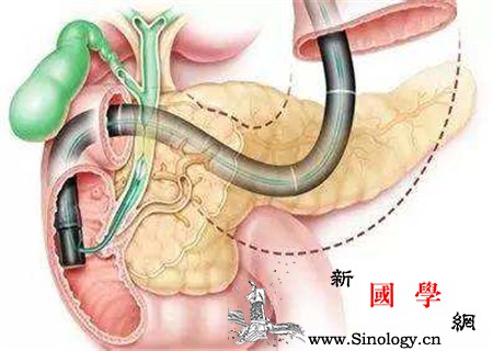 胎粪会导致肠管扩张吗这些影响要知晓_肠管-羊水-肠道-胎儿-
