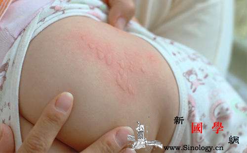 宝宝吃海鲜过敏怎么办_瘙痒-用量-用法-功效-