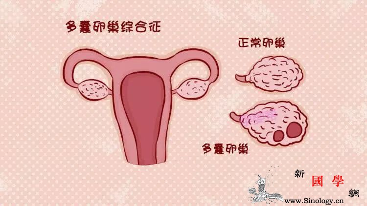 患有多囊卵巢综合征该怎么备孕？这3招你一定要_调理-肥胖-天王-排卵-怀孕准备