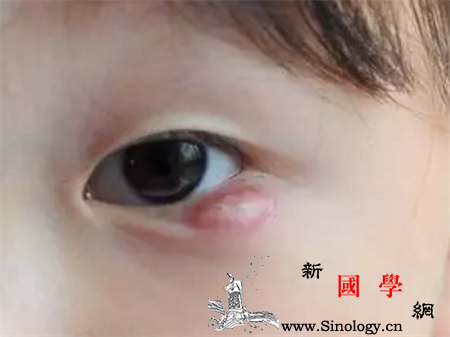 宝宝霰粒肿怎么引起的_年龄组-上火-细菌-生活习惯-