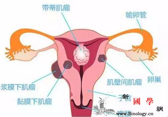 子宫肌瘤患者的饮食宜忌！_雌激素-肌瘤-豆制品-胆固醇-怀孕准备