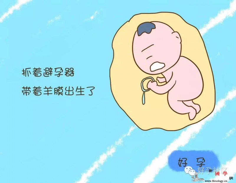 带环后意外怀孕宝宝出生后医生都傻眼了_避孕-怀孕后-宝宝-膀胱-