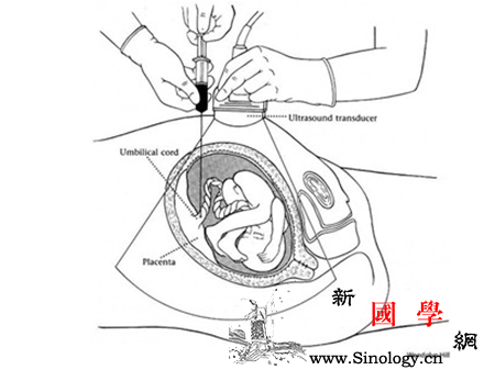 羊水穿刺必须要做吗_羊水-染色体-穿刺-胎儿-