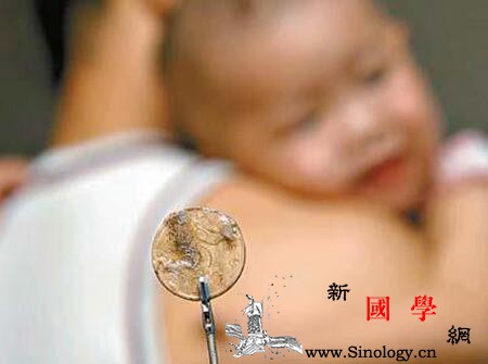 两岁幼儿误食硬币警车护送抢救及时_误食-食道-儿童医院-硬币-