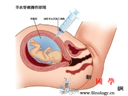 羊水穿刺和无创dna哪个更准确_羊水-组合-染色体-检出-