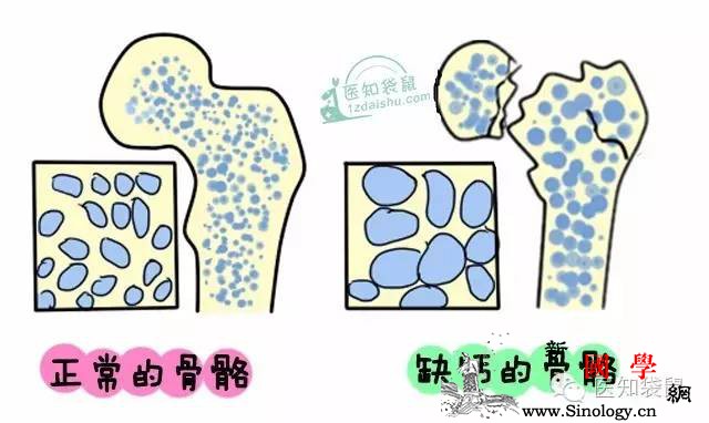 孕期缺钙了？后果可能很严重！_草酸-孕期-骨骼-维生素-