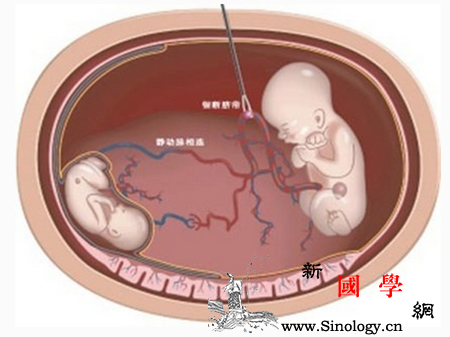 羊水穿刺羊膜多久闭合_羊膜-羊水-穿刺-闭合-