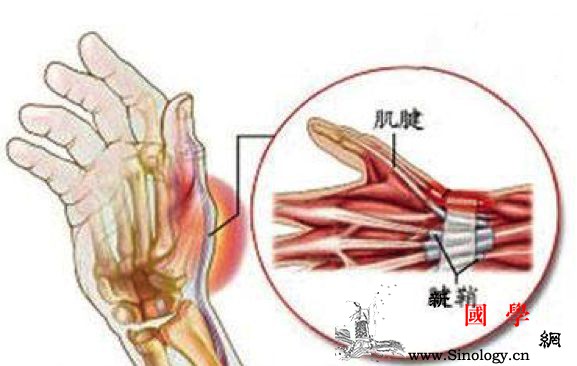 产后手腕疼是怎么回事？当心腱鞘炎_腱鞘-桡骨-肌腱-疼痛-