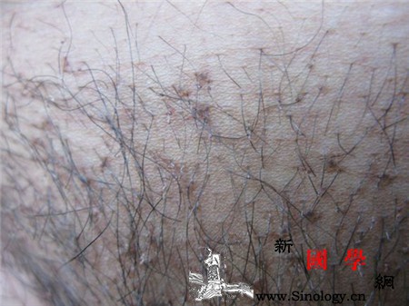 阴虱好了还复发吗怎样才能预防阴虱呢？_阴虱-青灰色-洗剂-瘙痒-怀孕准备