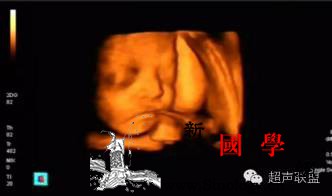 胎儿产前四维超声注意事项_产前-超声-胎儿-畸形-