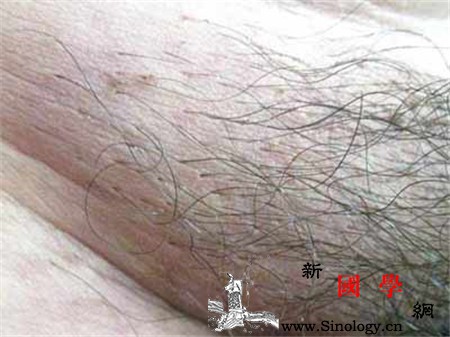 阴虱会不会引起梅毒阴虱会导致性病吗？_阴虱-青灰色-梅毒-会不会-怀孕准备