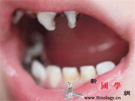 宝宝门牙龋齿能补牙吗补牙需要注意哪些问题_恒牙-乳牙-补牙-龋齿-