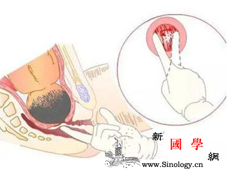 胎儿臀位宫口会开吗_顺产-阵痛-产妇-分娩-