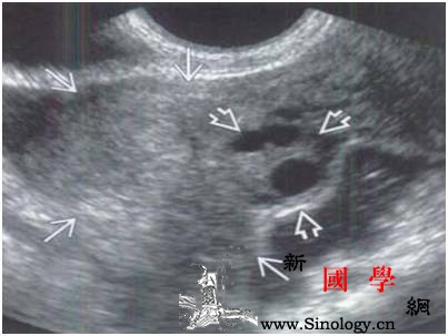 超声诊断异位妊娠黄体可能是“路标”！_环状-输卵管-卵巢-回声-