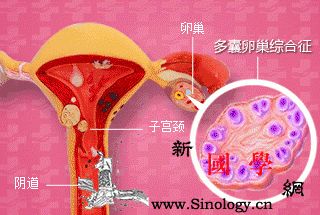 多囊卵巢综合征需要做哪些检查？_卵泡-卵巢-综合症-激素-孕前检查