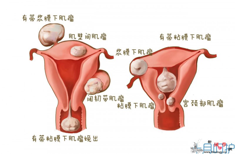 宝宝要出来产道却被子宫肌瘤堵住了！_肌瘤-孕期-子宫肌瘤-产道-