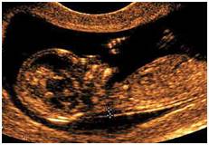 胎儿四大监护一个都不能少_基线-宫内-监护-胎儿-