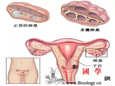 你真的了解多囊卵巢综合征吗？_排卵-症候-综合征-代谢-孕前检查