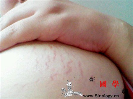妊娠纹什么时候开始长_皮下组织-出现在-腹部-孕妇-