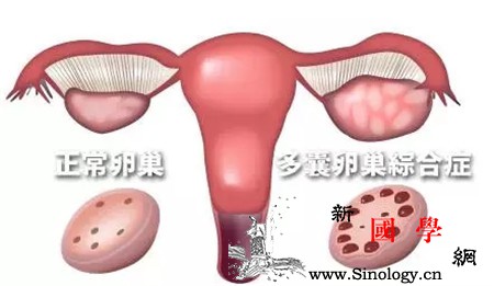 鹿胎膏可以治疗多囊吗多囊到底应该如何治疗呢_鹿胎-卵巢-月经-服用-怀孕准备