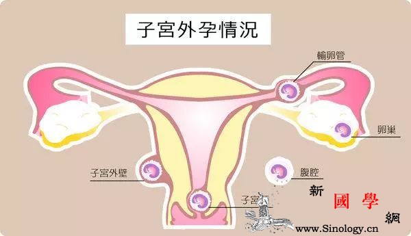宫外孕能预防？备孕前请小心身体发出的这些信号_受精卵-宫外孕-输卵管-着床-怀孕准备