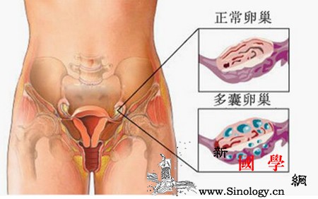 多囊卵巢泌乳素高怎么办_苏木-催乳素-闭经-血清-怀孕准备