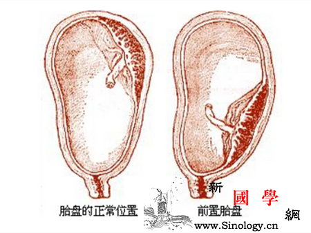 胎盘前壁和前置胎盘一样吗_受精卵-胎盘-宫颈-植入-