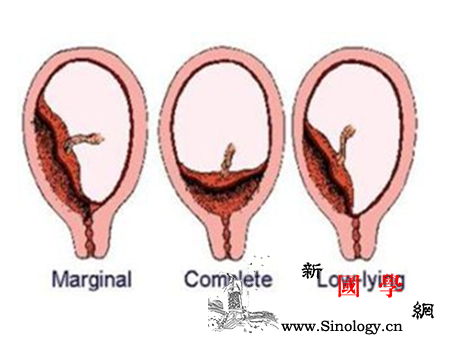 胎盘前壁和胎盘前置有什么区别_胎盘-附着-妊娠-分娩-