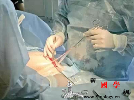 胎盘前壁可以剖腹产吗_产道-腹膜-胎盘-剖腹产-