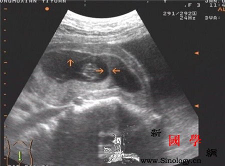 孕囊停止发育会有什么症状_染色体-胚胎-胎儿-流产-