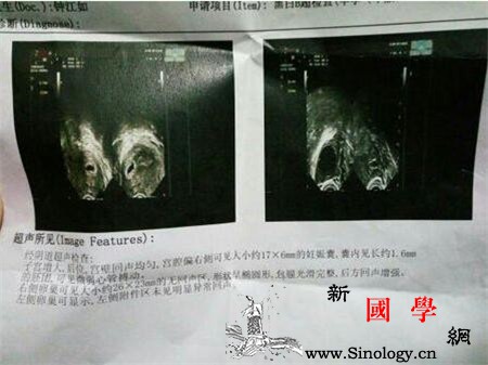 孕囊积液怎么引起_宫内-炎症-超声-阴道-