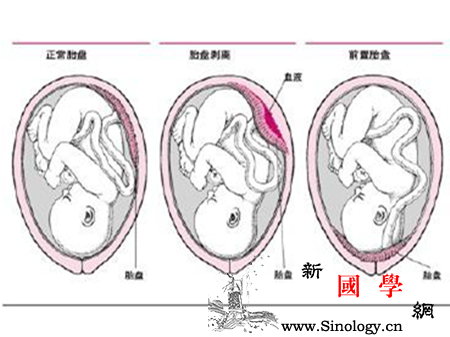前置胎盘和胎盘早剥的区别_外出血-子宫颈-胎盘-失血-
