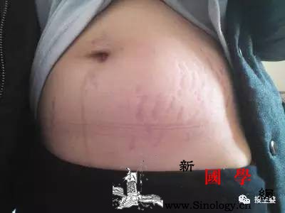 妊娠纹、肚中线、脐黑圈？为什么有的孕妇都有_黑线-肚脐-妊娠-孕妇-