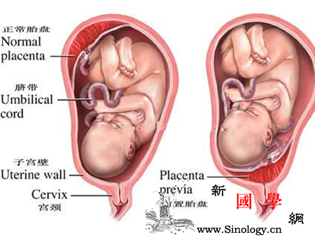 前置胎盘为什么容易引起出血_胎盘-妊娠-分娩-胎儿-
